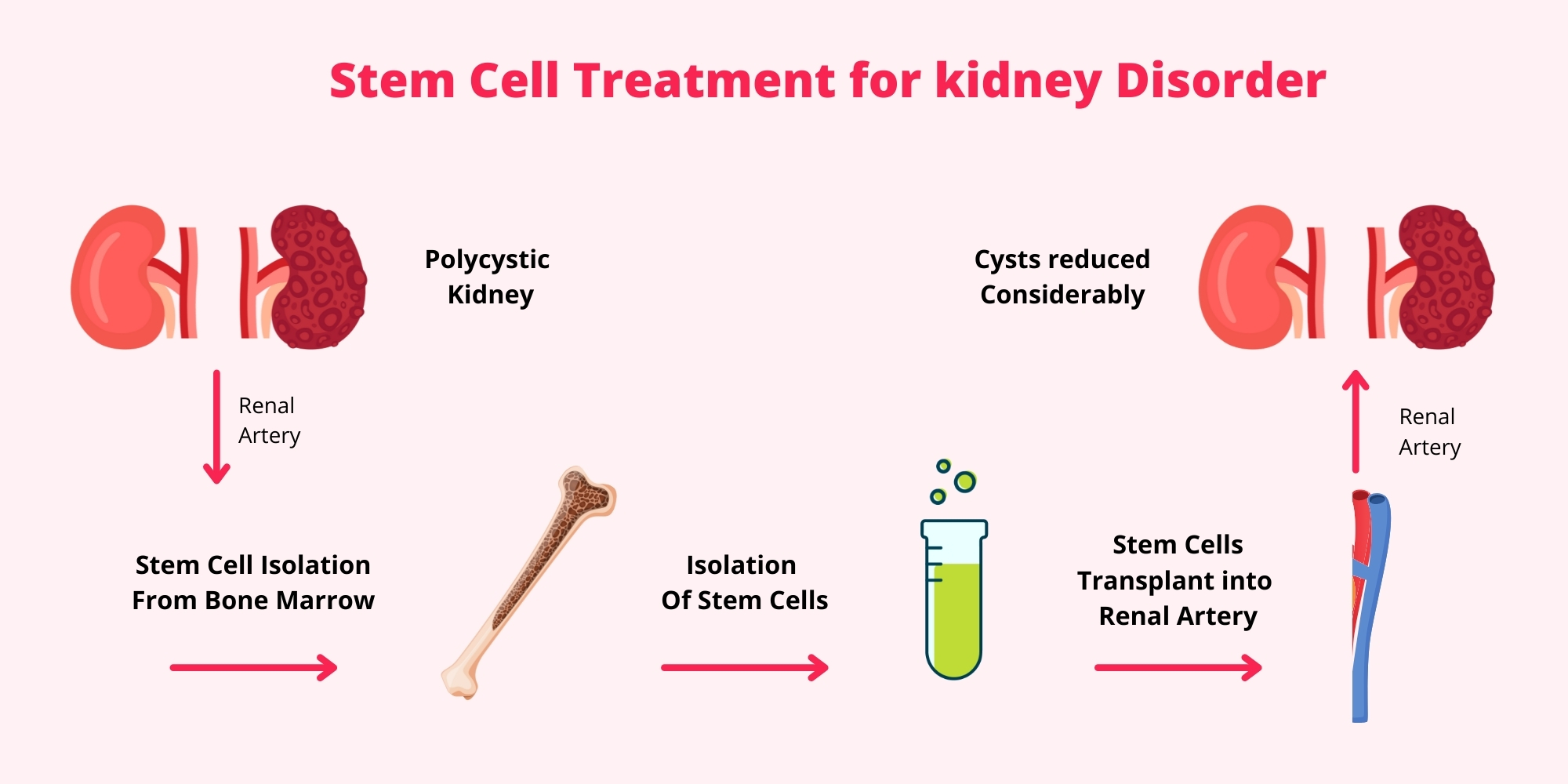 Stem-Cell-Therapy-for-Kidney-diseases